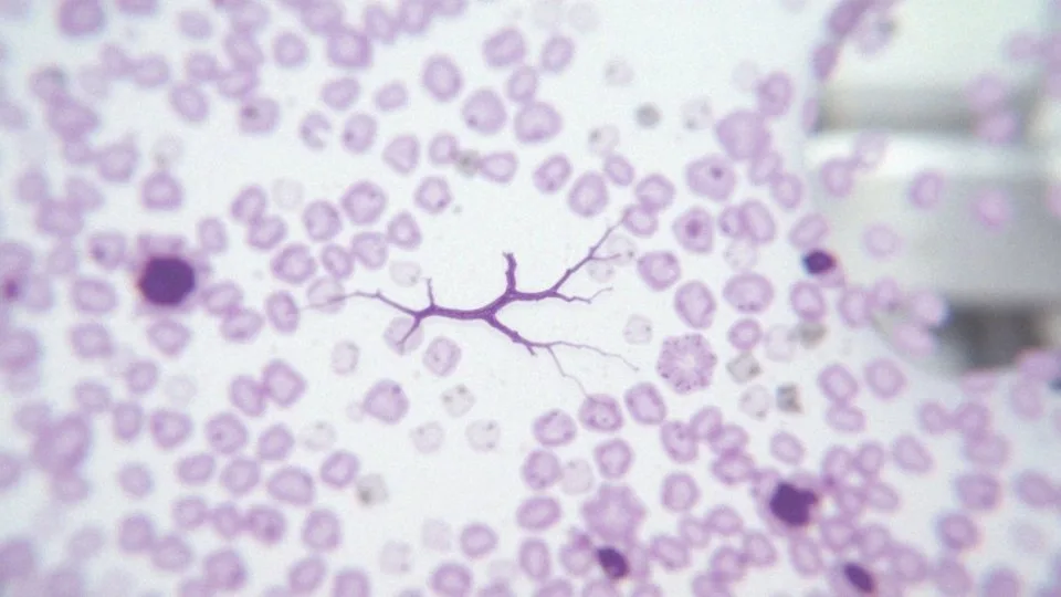 Neuroinwazja – co to znaczy i jakie ma znaczenie w onkologii?